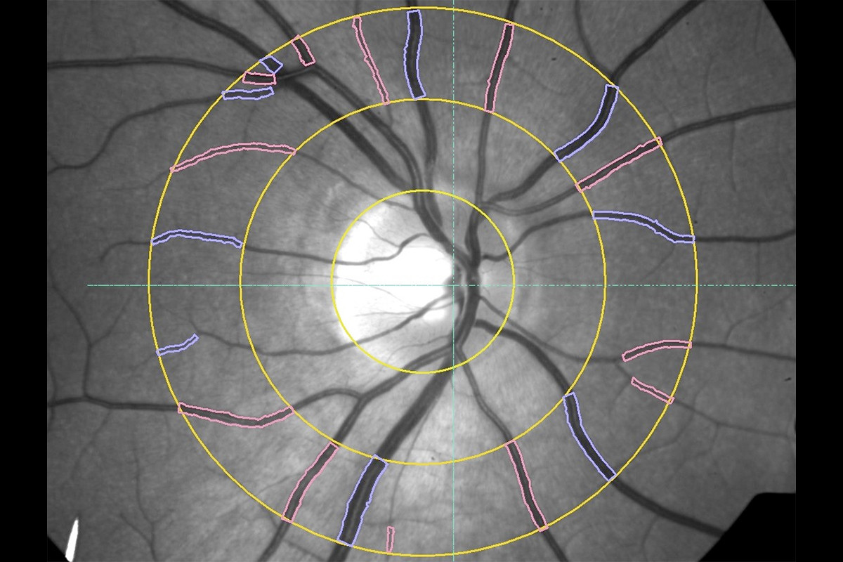 VesselMap aric: Image of the ocular fundus with measuring range