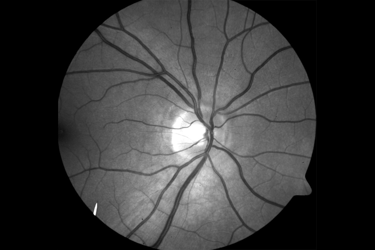 VesselMap aric: Image of the ocular fundus